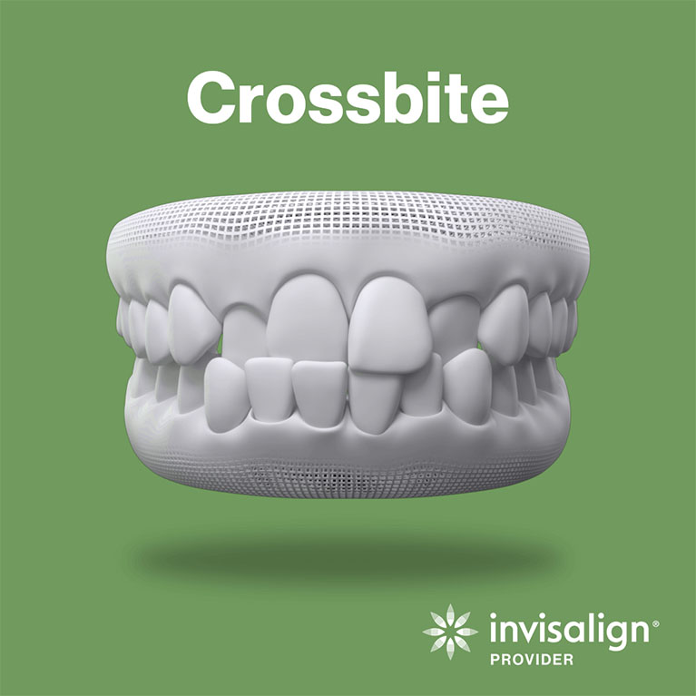 Crossbite Teeth