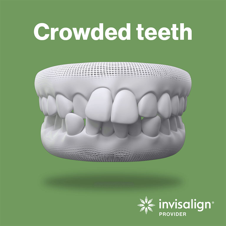 Crowded Teeth
