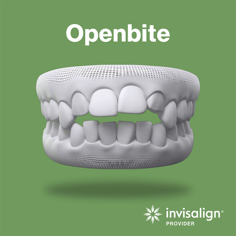 Openbite Teeth