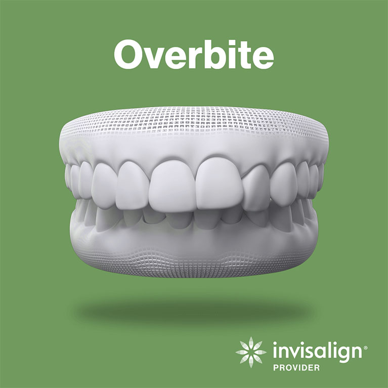 Overbite Teeth